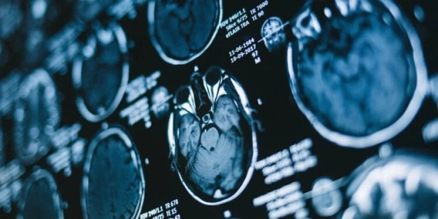 Kovid'in görünmeyen etkisi yıllar sonra ortaya çıktı!