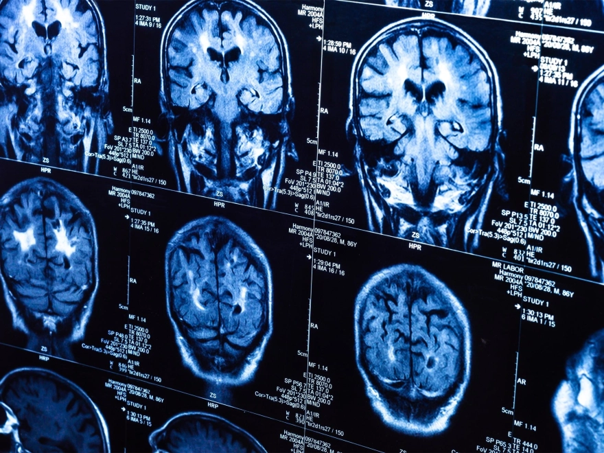 Kovid'in görünmeyen etkisi yıllar sonra ortaya çıktı!