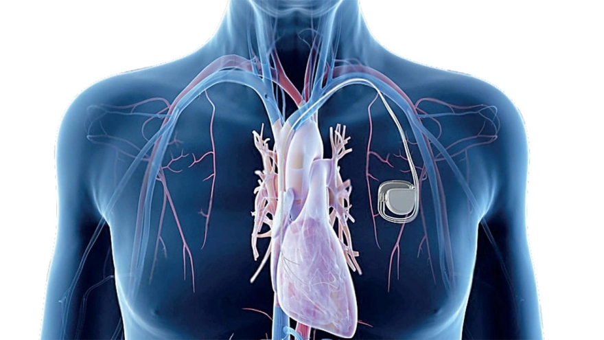 Kalp pili, stent ve bypass hangi durumlarda ne zaman uygulanır?